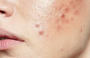 Acne Treatments in Aligarh